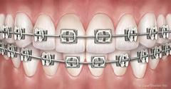 Orthodontics for Teens: Metal Braces