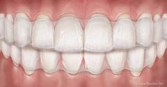 Invisalign Clear Aligners: Merced Orthodontist