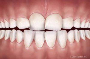 Common Orthodontic Problems - Crowding | Orthodontics Exclusively