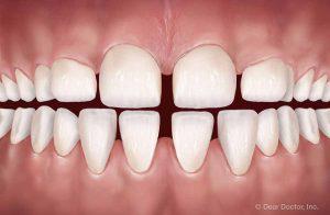 Common Orthodontic Problems - Excessive Spacing | Orthodontics Exclusively