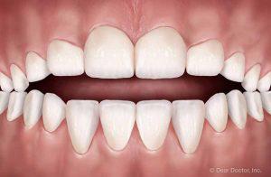 Common Orthodontic Problems - Open Bite | Orthodontics Exclusively