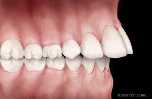 Common Orthodontic Problems - Overjet | Orthodontics Exclusively