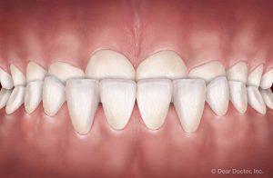 Common Orthodontic Problems - Underbite | Orthodontics Exclusively