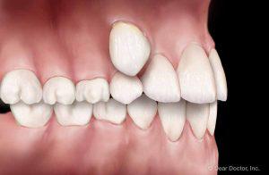 Common Orthodontic Problems - Eruption | Orthodontics Exclusively
