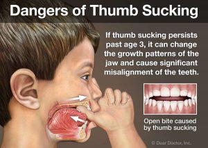 Dangers of thumb sucking: Orthodontics Exclusively | Merced
