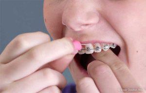 Who To Floss with Braces: Merced Orthodontist