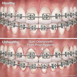 Orthodontics in Merced & Fresno: Braces