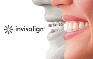Invisalign® Orthodontist in Merced, CA