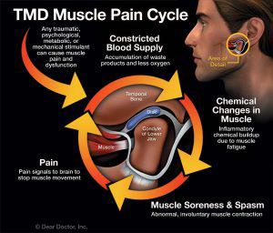 TMJ Pain Cycle and Symptoms: Orthodontics Exclusively