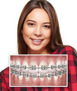 Traditional Metal Braces: Orthodontics in Merced