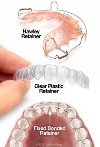 Types of orthodontic retainers: Merced Orthodontists
